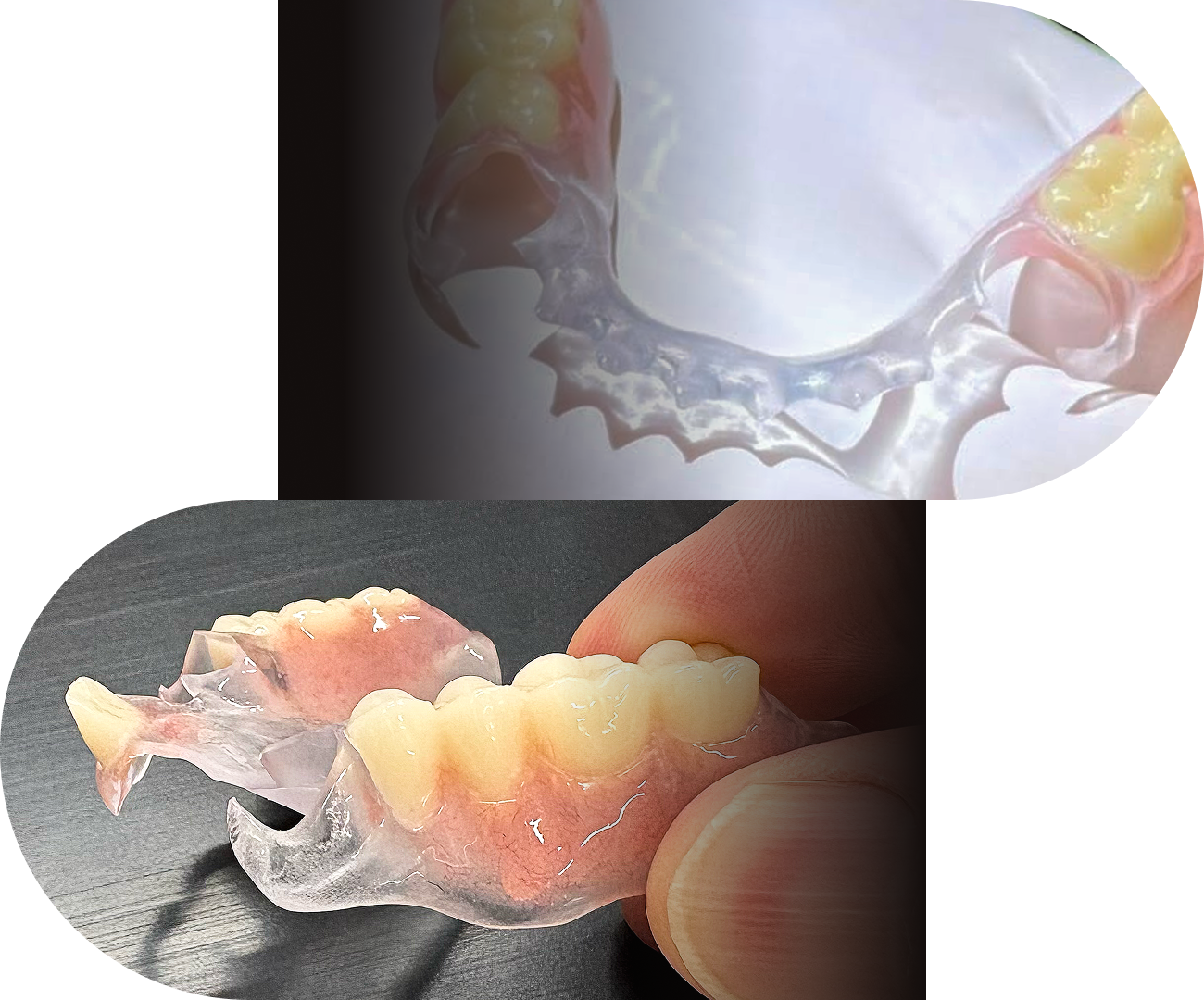 薄さ・軽さ・強度のバランスを考えた入れ歯